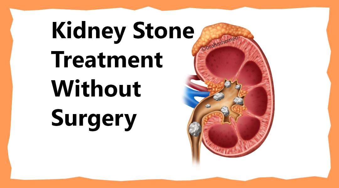 Kidney Stone | Kidney Stone Treatment | Kidney Stone Treatment In Homeopathy