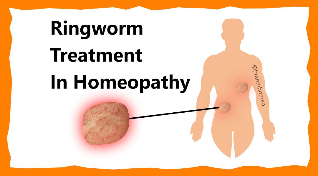 Ringworm (Tinea Corporis): What It Looks Like, Causes & Treatment