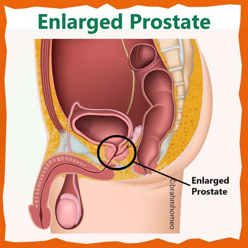 ENLARGED-PROSTATE-treatmemnt-in-homeopathy