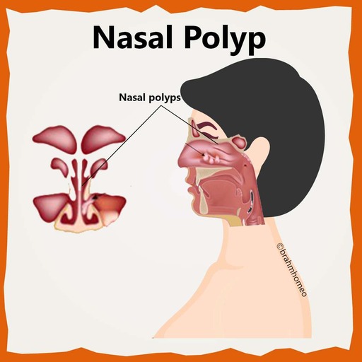 Nasal-polyp-curative-treatment-in-homeopathy