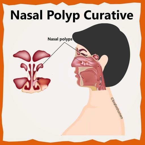 Nasal-polyp-curative-treatment-in-homeopathy