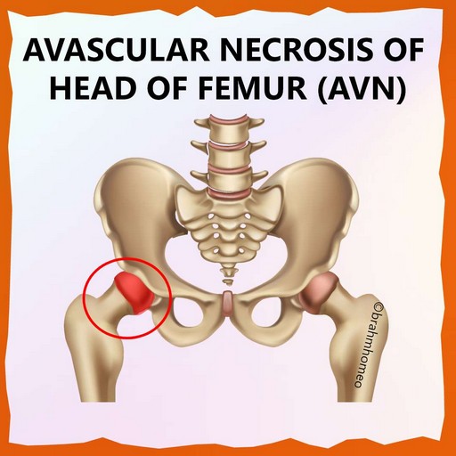 AVN-treatment-in-homeopathy