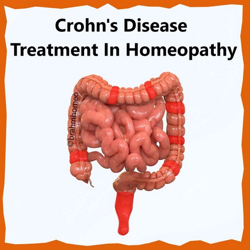 crohn's-disease-treatment-in-homeopathy