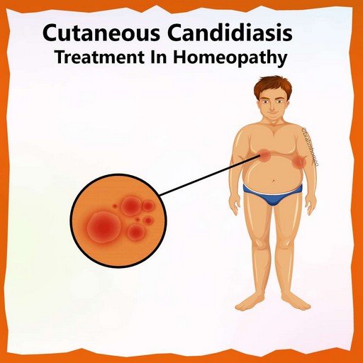 Cutaneous Candidiasis Cutaneous Candidiasis Treatment