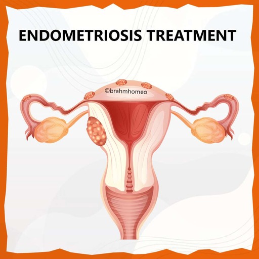 endometriosis-treatment-in-homeopathy