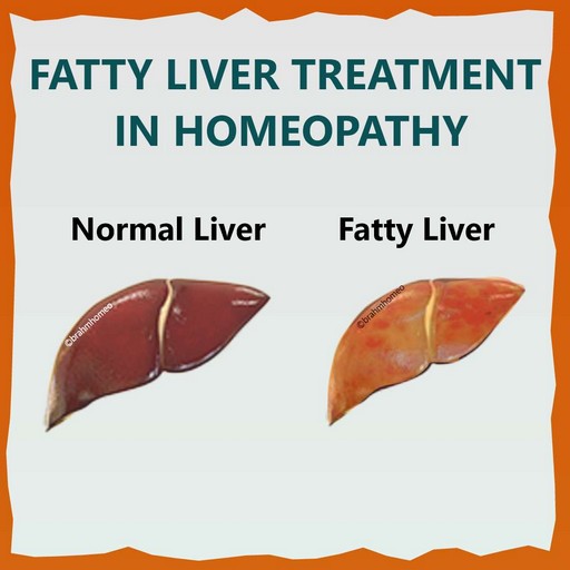 fatty-liver-treatment