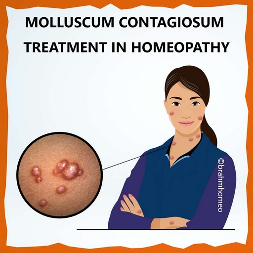 molluscum-contagiosum-treatment-in-homeopathy