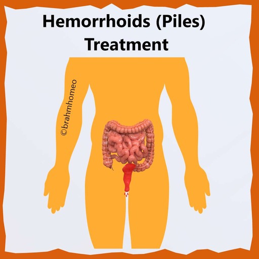 piles-treatment-in-homeopathy