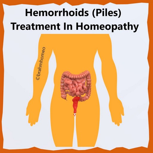 piles-treatment-in-homeopathy