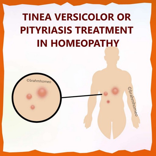 pityriasis-treatment-in-homeopathy