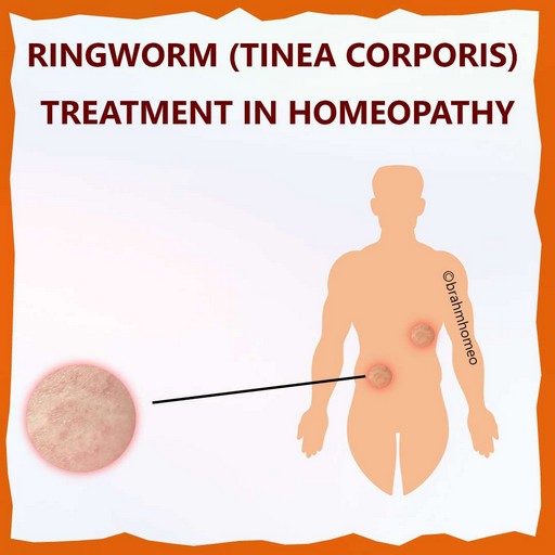 ringworm-treatment-in-homeopathy