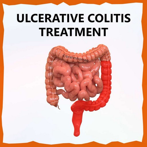 ulcerative-colitis-treatment-in-homeopathy