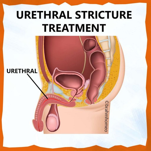urethral-stricture-treatment-in-homeopathy