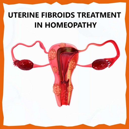 uterine-fibroids-treatment-in-homeopathy