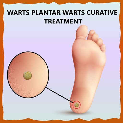 warts-curative-treatment-in-homeopathy