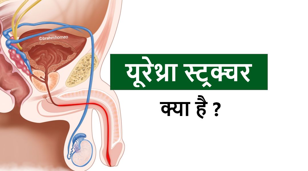 पुरुषों में गलत अंडरवियर से 25% तक घट